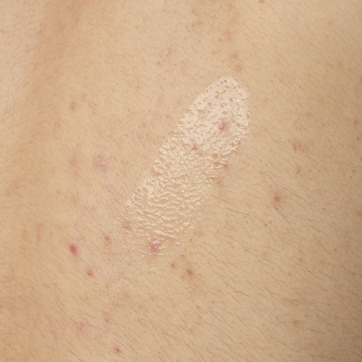 salicylic-acid-0-5-body-serum-h1 ORD-salicylic-acid-05-body-240ml-application.jpg