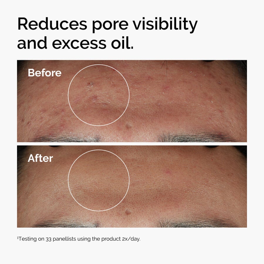 niacinamide-10-zinc-1-b0 ord-niacinamide-zinc-blemish-serum-before-after-pores.jpg
