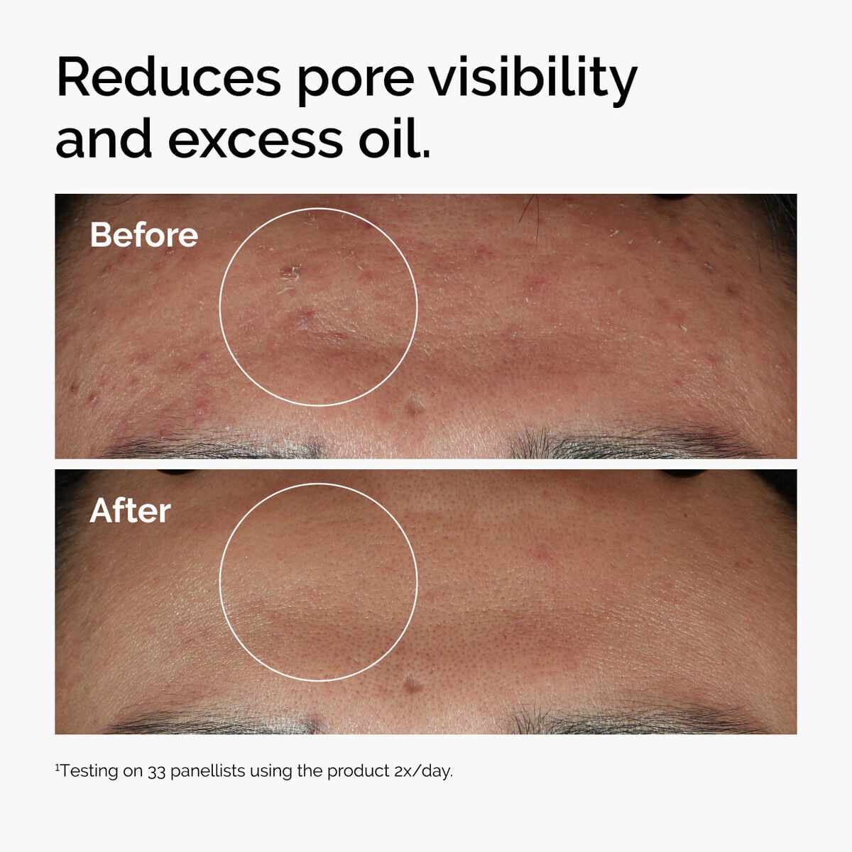 niacinamide-10-zinc-1-b0 ord-niacinamide-zinc-blemish-serum-before-after-pores.jpg