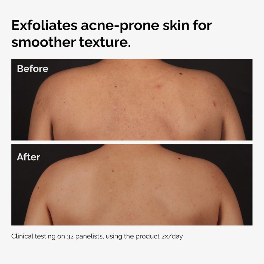 the-body-care-collection-i5 ord-salicylic-acid-body-serum-before-after-graphic-NA.jpg