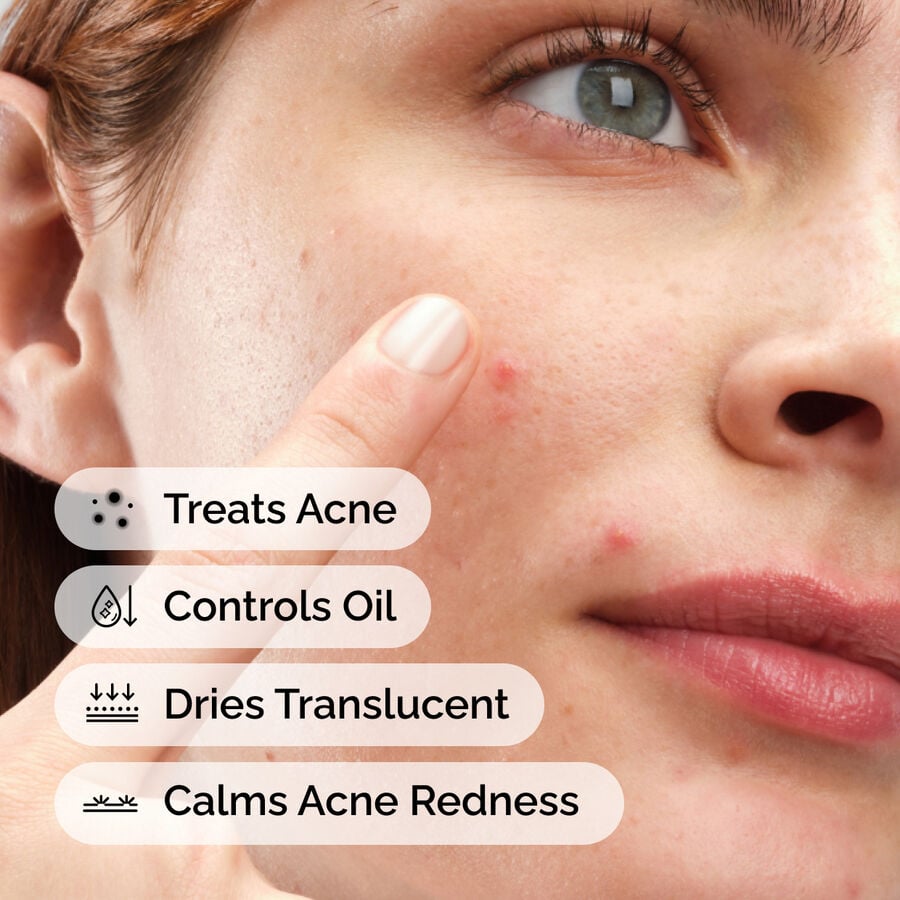 sulfur-10-powder-to-cream-concentrate-h4 ord-sulfur-10pct-powder-to-cream-concentrate-model-application-with-benefits-acne.jpg